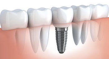 Dental Implants in Fresno CA